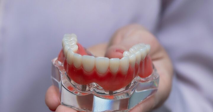 „Visi dantys ant 4“: kas tai ir kaip veikia?